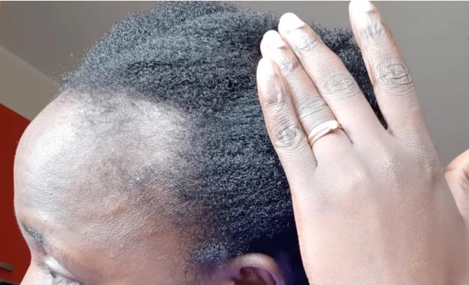 Scalp therapy treatment for seborrheic dermatitis and hair loss